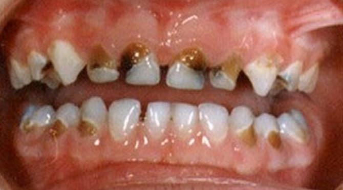 Diş çürüğü böbrek hastalığına neden oluyor 