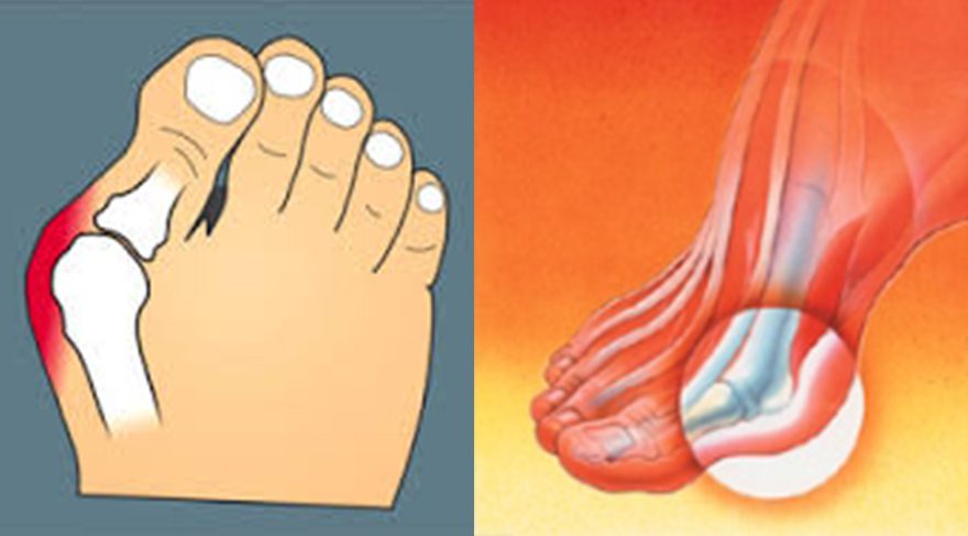 Ayak başparmağı çıkıklarının verdiği rahatsızlıkların büyük kısmı cerrahi operasyonlara gerek kalmadan doğru ayakkabı ve tabanlık kullanımı ile azaltılabilmektedir.