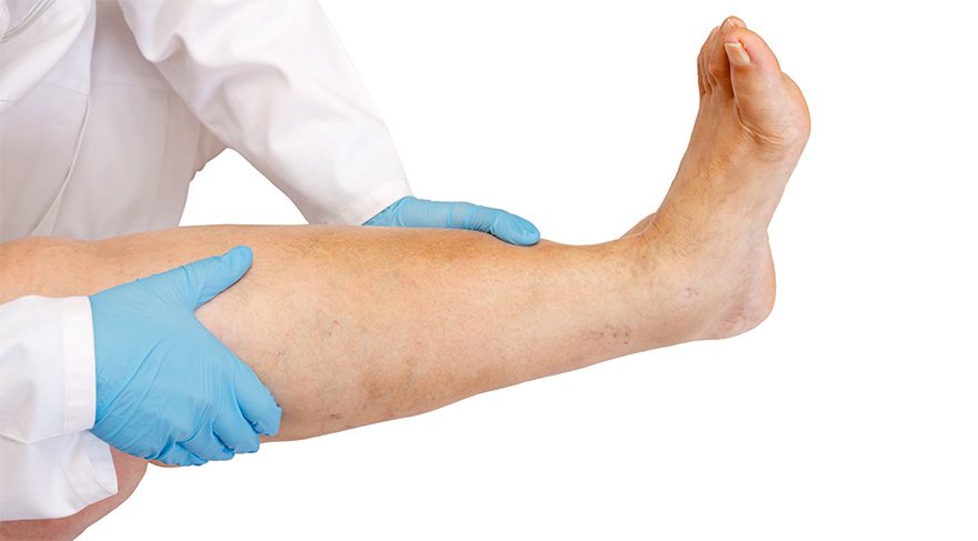 Tek bacaktaki ödeme dikkat!