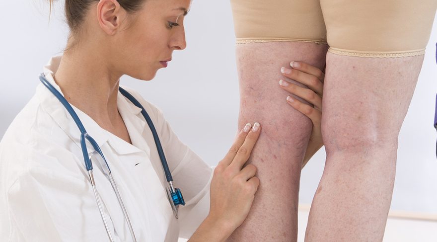 Varisler aslında genel olarak ailesel yatkınlıkla beraber ortaya çıkan bir hastalık.