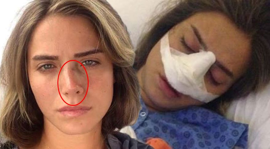 Ceyda Ateş'ten estetik burun cevabı