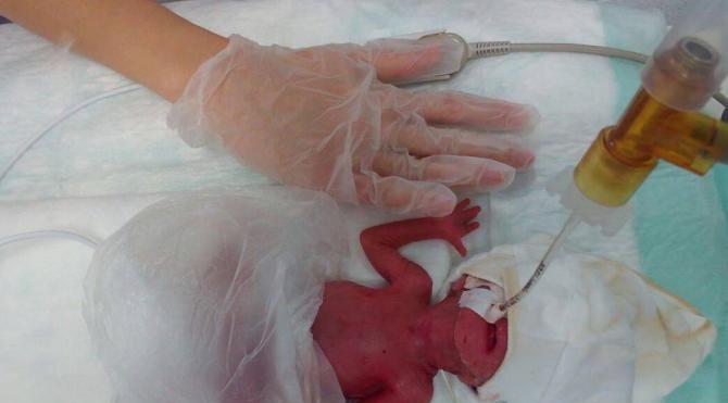 380 gram doğmasına rağmen yaşama tutunan Azra bebek bu töreni hak etti