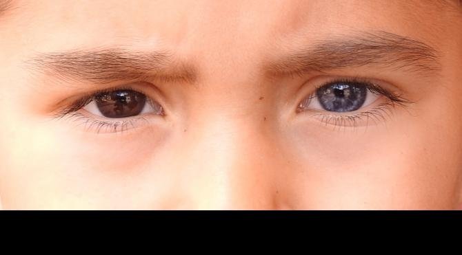Küçük Hüseyin&#39;in bir gözü mavi diğeri kahverengi