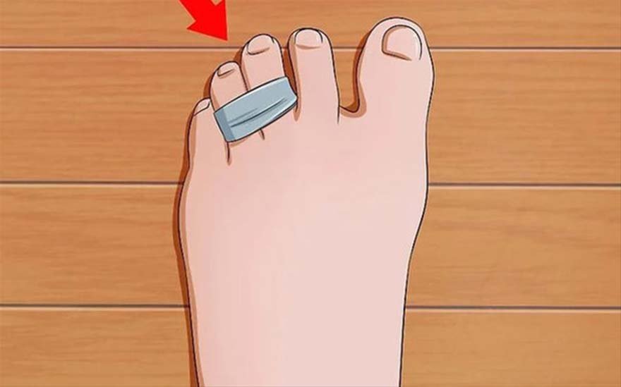 Bant kullanarak ayağınızdaki üçüncü ve dördüncü parmağını birbirine yapıştırın. Bu bağlama işlemi, ayak ağrınızın azalmasına büyük ölçüde yardımcı olacaktır.Bunun nedeni ise bu iki parmağın arasında yer alan sinirdir. Parmaklar bantlandığında ağırlık sinirinize eşit bir şekilde baskı yapar ve böylece ayağınızdaki ağrı azalmış olur.