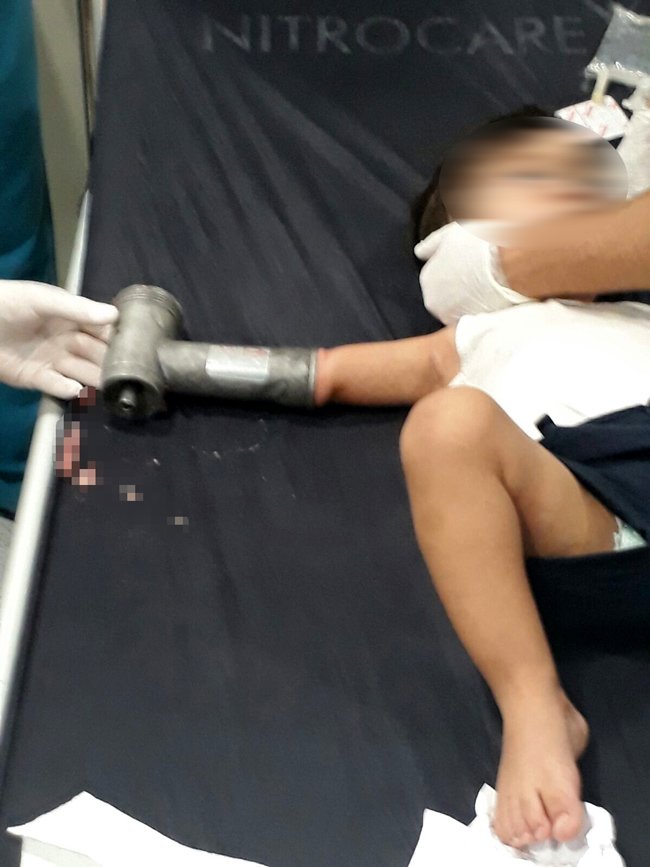 kiyma-makinesine-kolunu-kaptiran-cocuklar-1