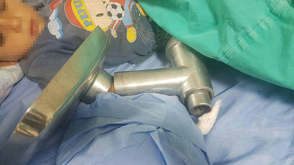 kiyma-makinesine-kolunu-kaptiran-cocuklar-2