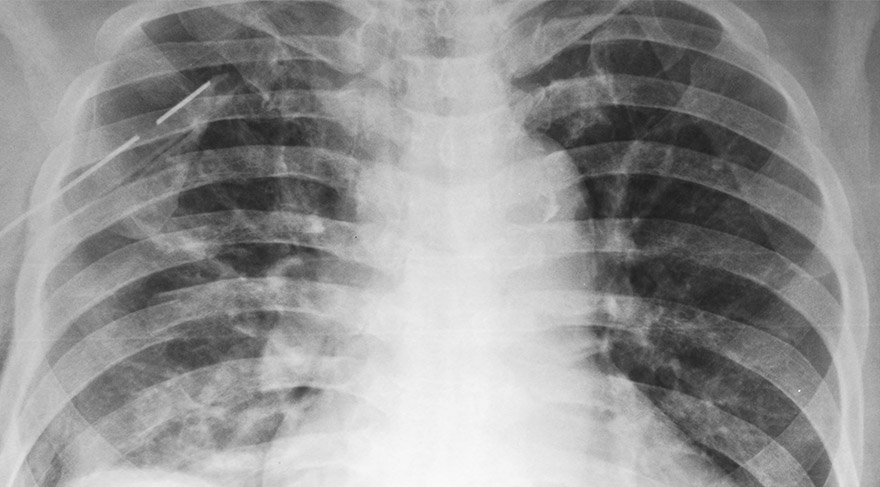 Akciğer sönmesi sorununun bir tedavisi var mı?