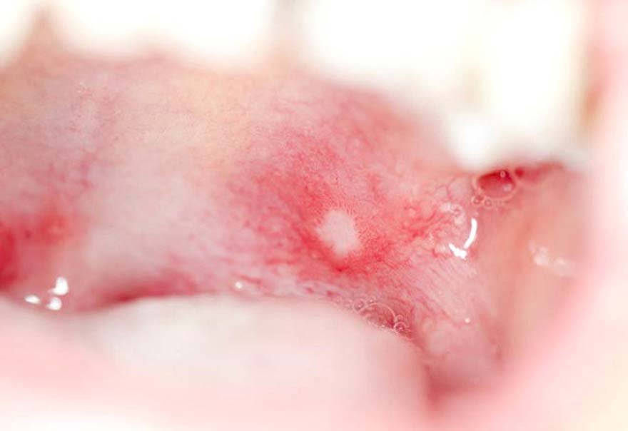 dil-kanserinin-en-erken-belirtileri-2-711033_2996_2_b