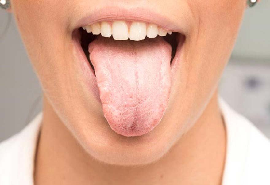 dil-kanserinin-en-erken-belirtileri-2-711033_7961_4_b