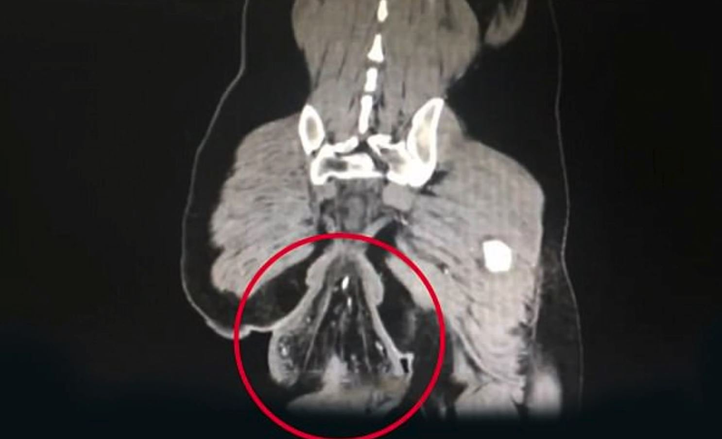Yapılan incelemeler sonucunda adamın anüsünden çıkan 16 santimetre çapındaki organın rektum olduğu belirlendi.