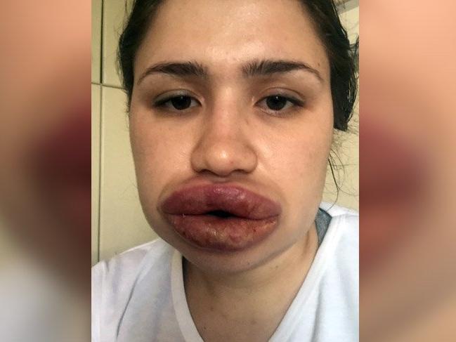 Silikon mağduru Merve hemşirenin dudakları eski haline döndü