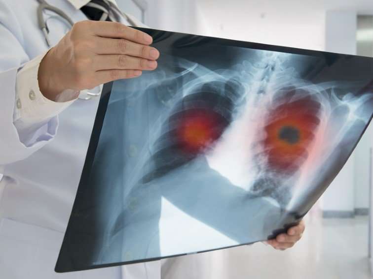Akciğer kanserine karşı immünoterapi tedavisi