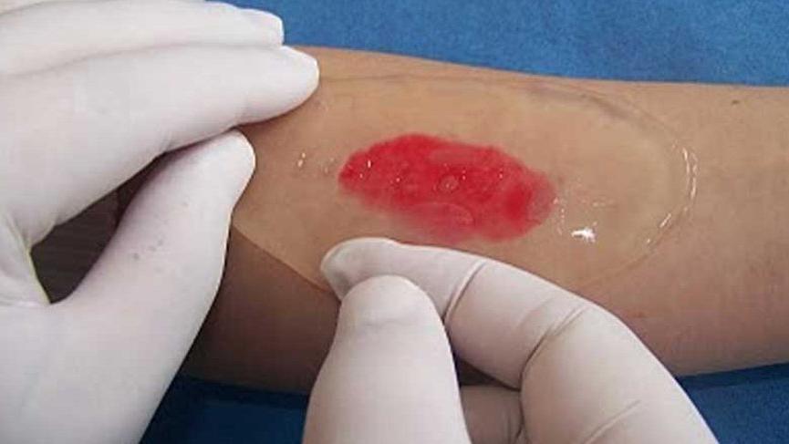 1. dereceden ve 2. dereceden yanık nedir? İşte yanık türleri ve tedavi yöntemleri...