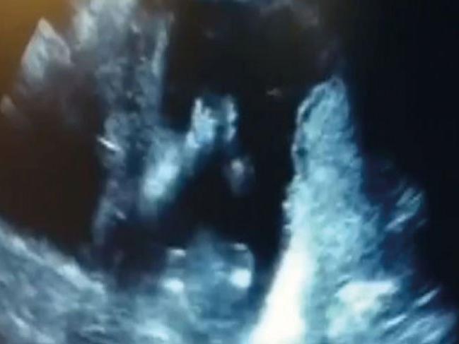 Ultrason görüntülerini paylaştılar! Anne karnındaki bebeği görenler yaptığına inanamadı