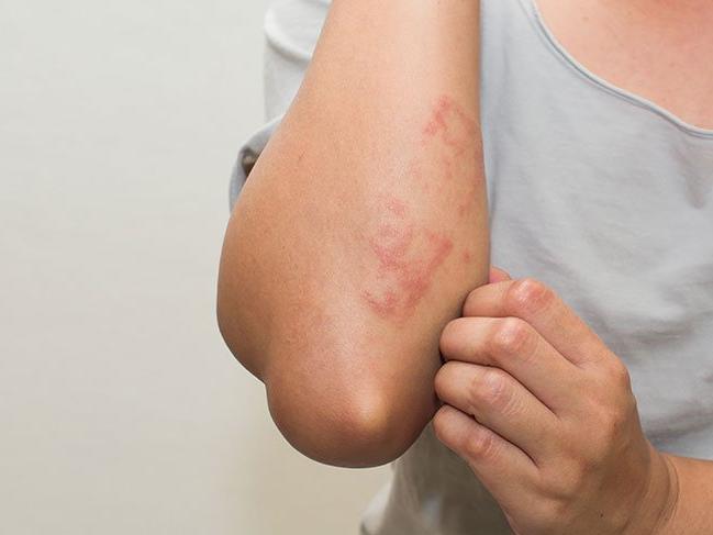 atopik dermatit rahatlama