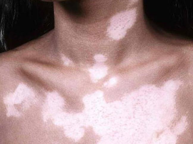 Vitiligo nedir? İşte belirtileri ve tedavi yöntemleri...