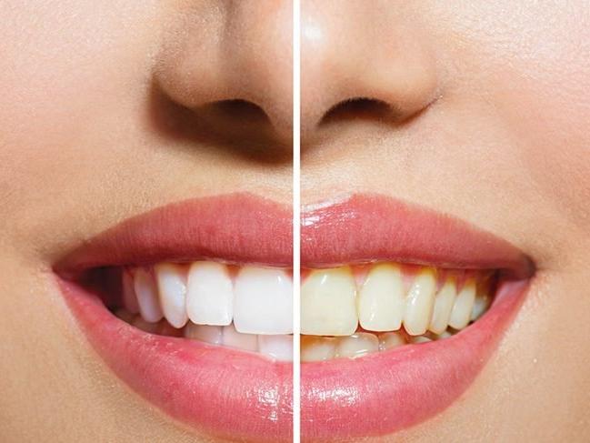 Diş beyazlatma nedir (Bleaching)? Diş beyazlatma yöntemleri