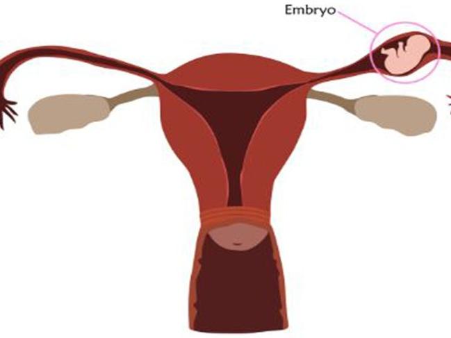 Dış gebelik nedir? Neden olur? İşte dış gebelik belirtileri ve tedavisi