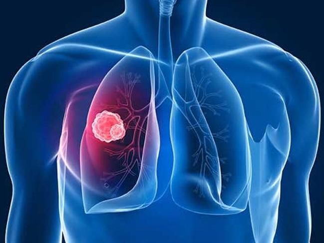 Akciğer kanseri nedir? Akciğer kanserinin nedenleri, belirtileri ve tedavisi...
