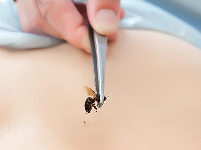 Arı sokması belirtileri neler? Arı sokması alerjisi nasıl anlaşılır? İşte tedavi önerileri...