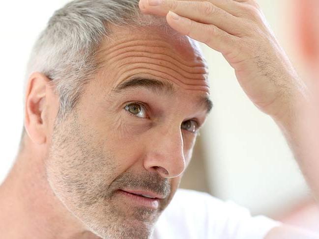 Saçkıran (Alopesi areata) nedir? Saçkıran hastalığının nedenleri, belirtileri ve tedavisi...