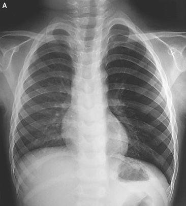 Çocuğun vücudunun sol tarafındaki şişlik röntgen sonuçlarında rahatlıkla görülüyor.