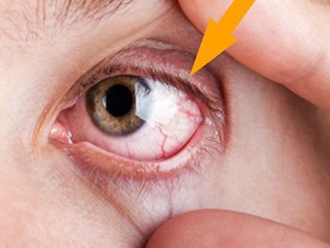 Göz enfeksiyonu nedir, nasıl olur? Göz enfeksiyonunun belirtileri ve tedavisi...