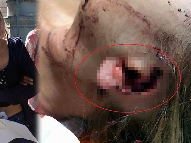 Genç kadın kavgada arkadaşının kulağını ısırarak kopardı