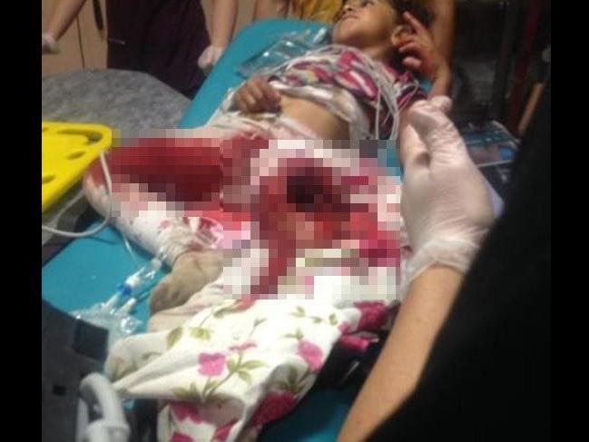 Patos makinesine düşen kız ağır yaralandı