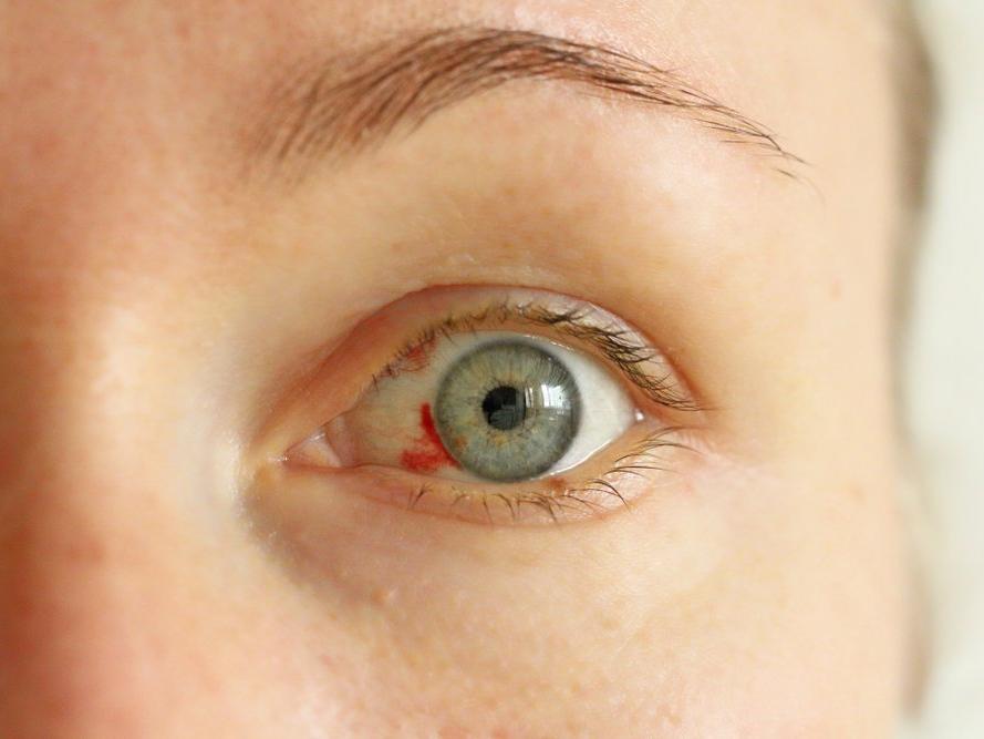 Göz kanlanması nedir? Göz kanlanmasının nedenleri ve tedavisi...