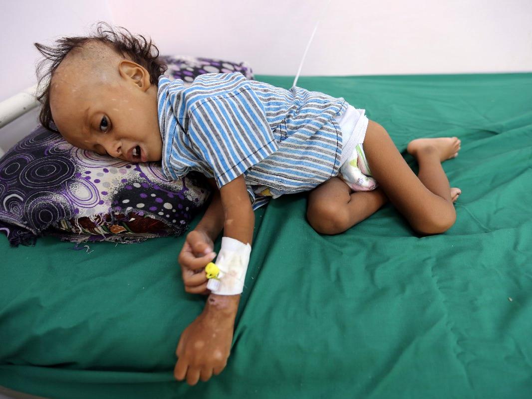 Herkes Kaşıkçı'yı konuşuyor ama Suudi Arabistan yüzünden 3 yılda 85 bin çocuk açlıktan öldü