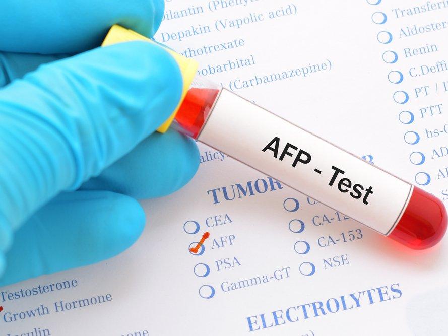AFP: Alfa Fetoprotein nedir? AFP yüksekliği ve düşüklüğü neden olur?