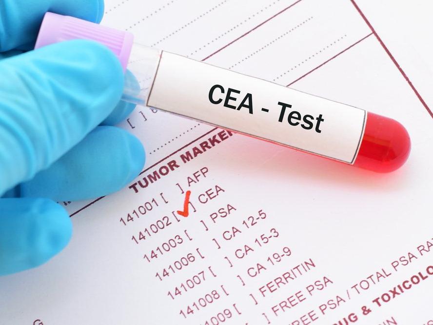 CEA: Karsinoembriyonik antijen nedir? CEA yüksekliği ne anlama gelir? CEA yüksekliğinin nedenleri...