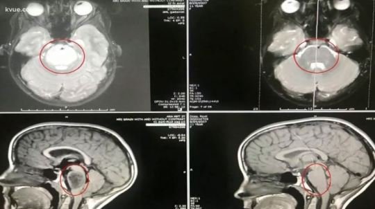 Soldaki MR'da tümör görülürken, son çekilen sağdaki MR'da tümör yok oldu. 