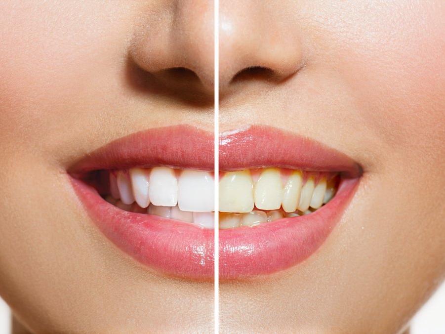 Dişlerimizin sararmasının nedeni nedir?