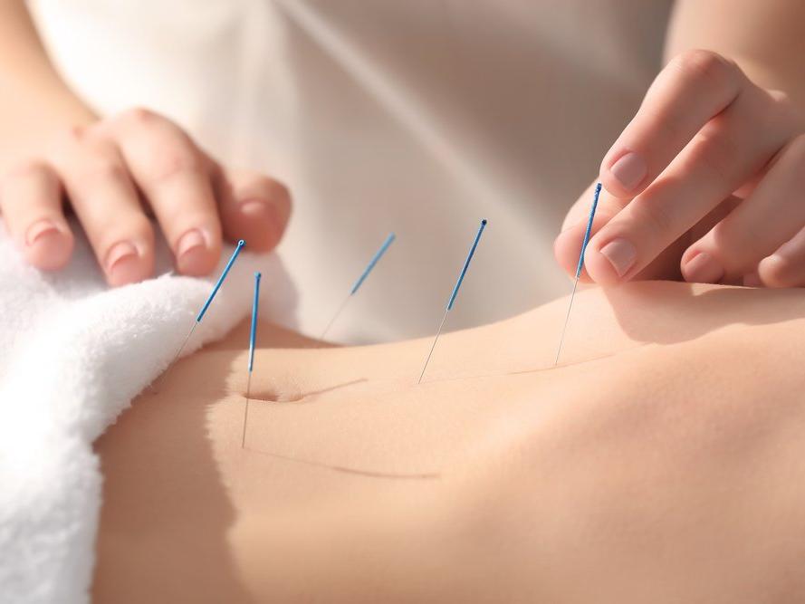 Akupunktur nedir? Akupunktur ne için kullanılır? Akupunkturun faydaları nelerdir?