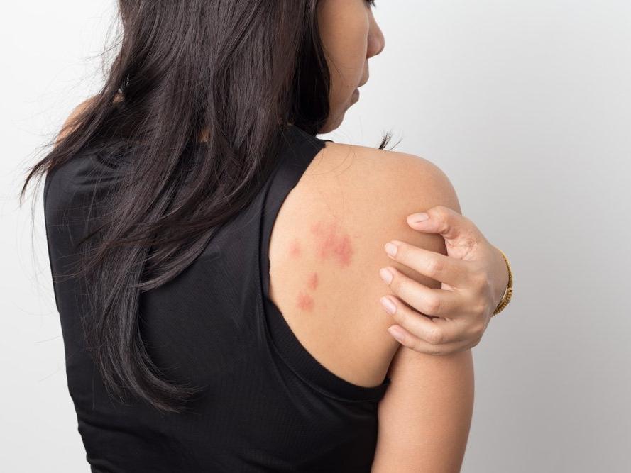 Atopik dermatit (Egzama) nedir? Atopik dermatit nedenleri, belirtileri ve tedavisi…