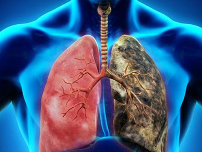Akciğer kanseri nedir, belirtileri nelerdir? İşte akciğer kanseri evreleri ve tedavisi