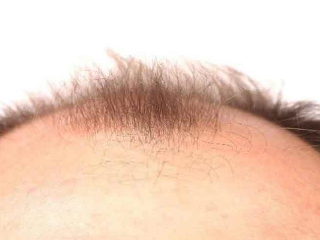 Saç dökülmesi nasıl önlenir?