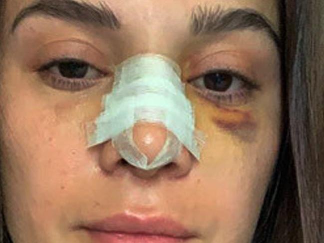 Sunucu Büşra Sanay burnunun kırıldığını sosyal medyadan duyurdu