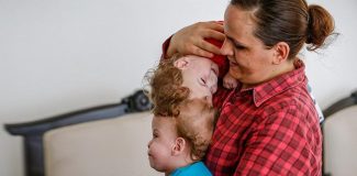 Kafadan yapışık siyam ikizleri bir yaşına girdi