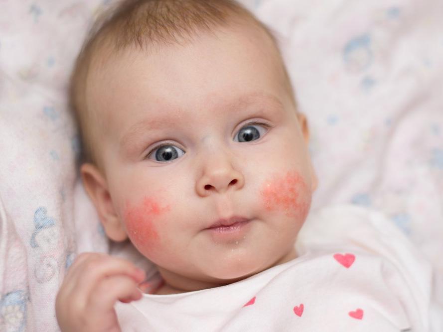 Bebeklerde cilt hastalıkları nelerdir?