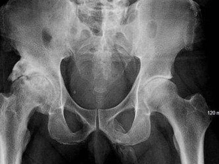 Doktorları şaşkına çeviren röntgen: Diz ağrısıyla gitti sonuç şok etti