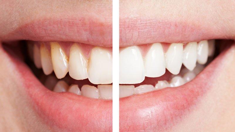 Doğal diş beyazlatma yöntemleri… Evde dişler nasıl beyazlatılır?