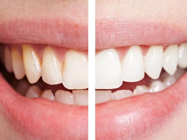 Doğal diş beyazlatma yöntemleri… Evde dişler nasıl beyazlatılır?