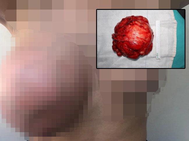 12 yaşındaki kızın memesinde tespit edilen yarım kiloluk tümör temizlendi