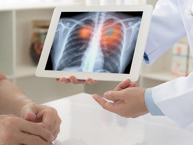 'Akciğer kanseri tedavisi kişiye özel olmalıdır'