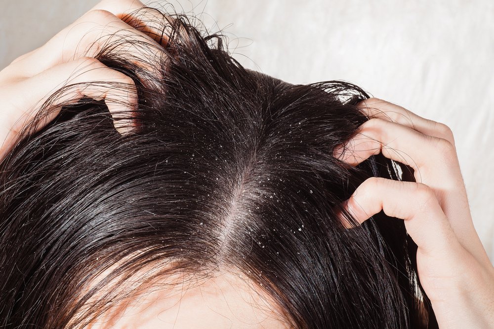 Saç kepeklenmesi nasıl geçer? Neden olur?