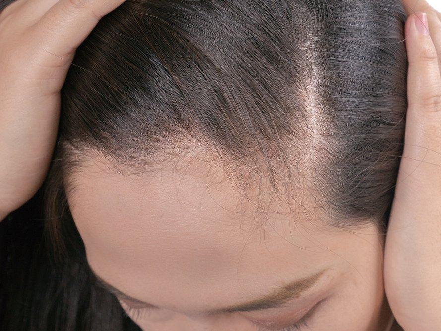 Saçkıran tedavisi nasıl yapılır? Saçkıran ne kadar sürede geçer?