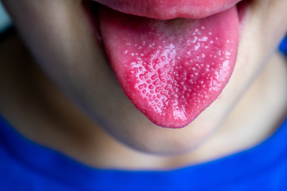 Paslı dil hangi hastalıkların belirtisidir?